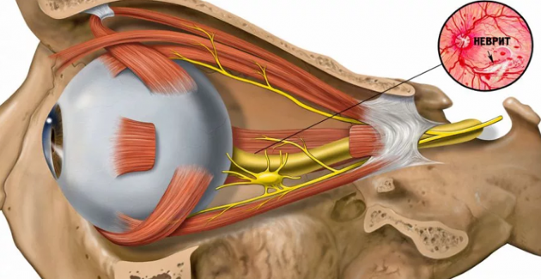 Фото зрительный нерв