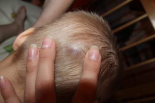 Шишечки на голове у ребенка 2 года