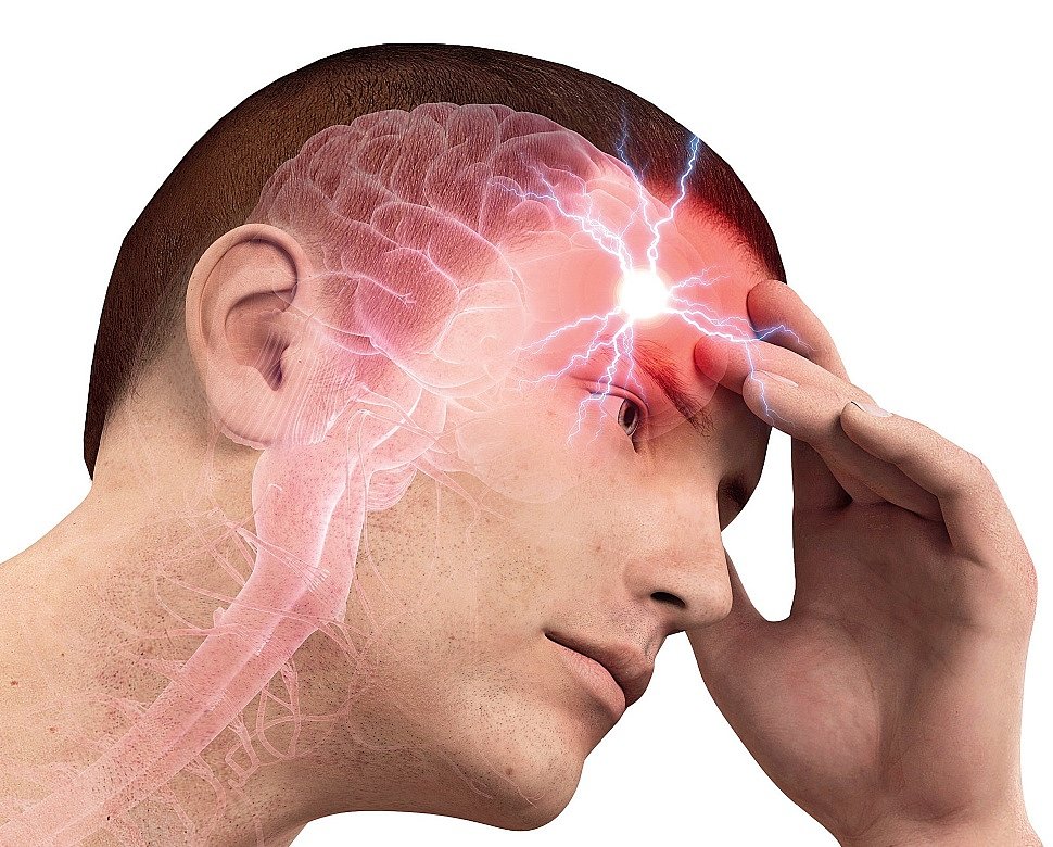Проблемы с головным мозгом симптомы. Головная боль. Головная боль мигрень. Что такое мигрень головы.