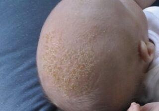 Желтая корка на голове у ребенка 4 года