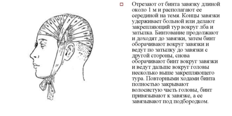 Как перебинтовать голову бинтом схема затылок