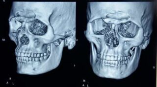 Перелом костей средней зоны лица