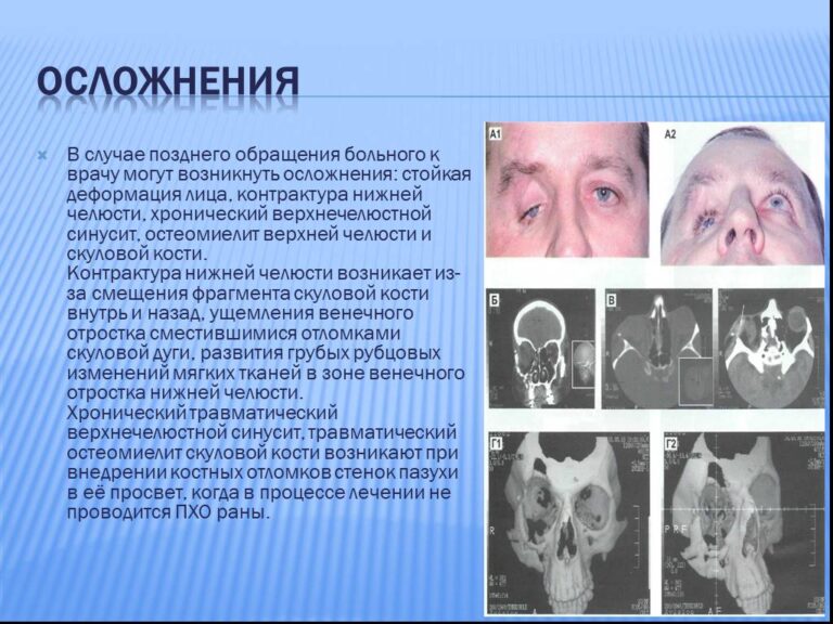 Перелом скуловой кости карта вызова