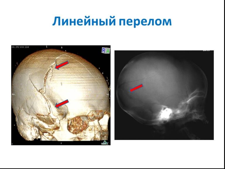 Теменная кость черепа фото