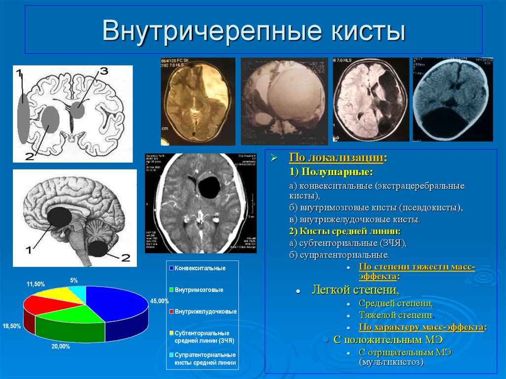 Киста мозг признаки. Арахноидальные кисты головного мозга классификация. Кистозные образования головного мозга. Опухоль головного мозга киста. Субарахноидальные кисты.