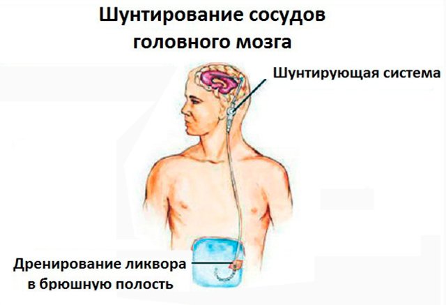 Шунт при гидроцефалии. Шунтирование желудочков мозга. Шунтирование гидроцефалии головного. Шунтирование гидроцефалии вентрикулоперитонеальное.