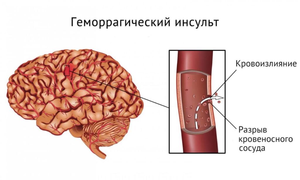 Гематомы при гемофилии фото