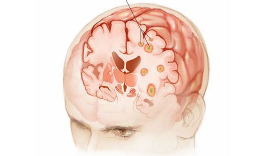Опухоль головного мозга первый симптом. Злокачественная глиома. Объемное образование головного мозга.