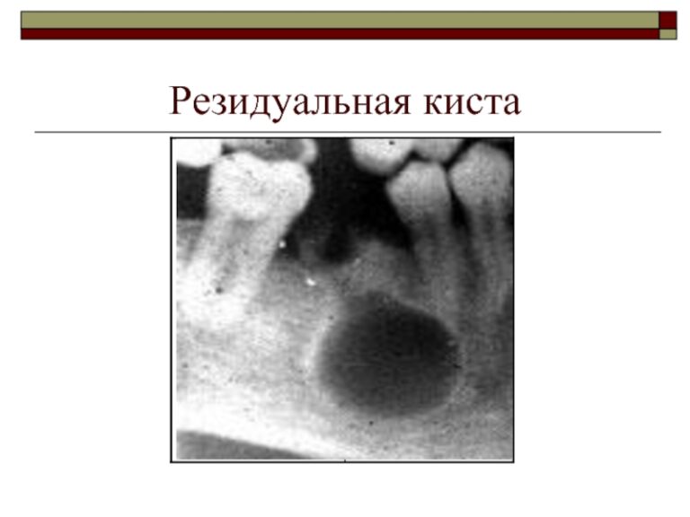 Радикулярная киста презентация