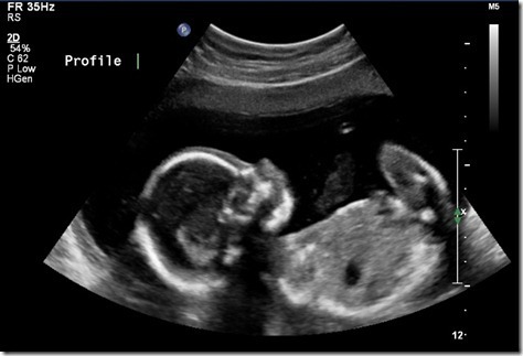 Кости в 13 недель. Малыш на 20 неделе беременности УЗИ. Носовая кость на УЗИ 20 недель.