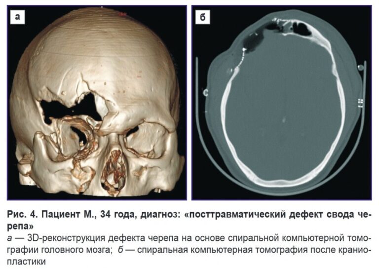 Фото после трепанации черепа
