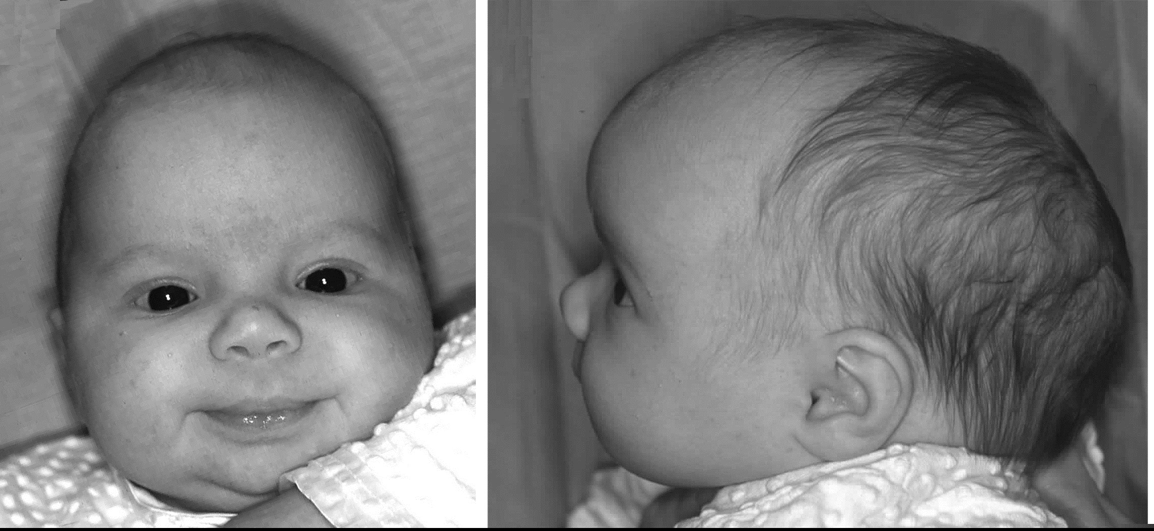Затылок норма. Долихолисеская форма головы у ребенка. Долихоцефалическая форма головы у плода. Долихоцефалическая форма головы у новорожденных. Долихоцефалия черепа у новорожденного.