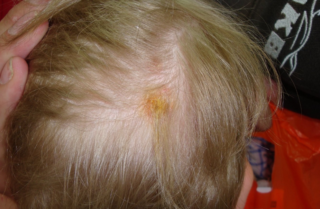 Ребенок 2 года болячки на голове