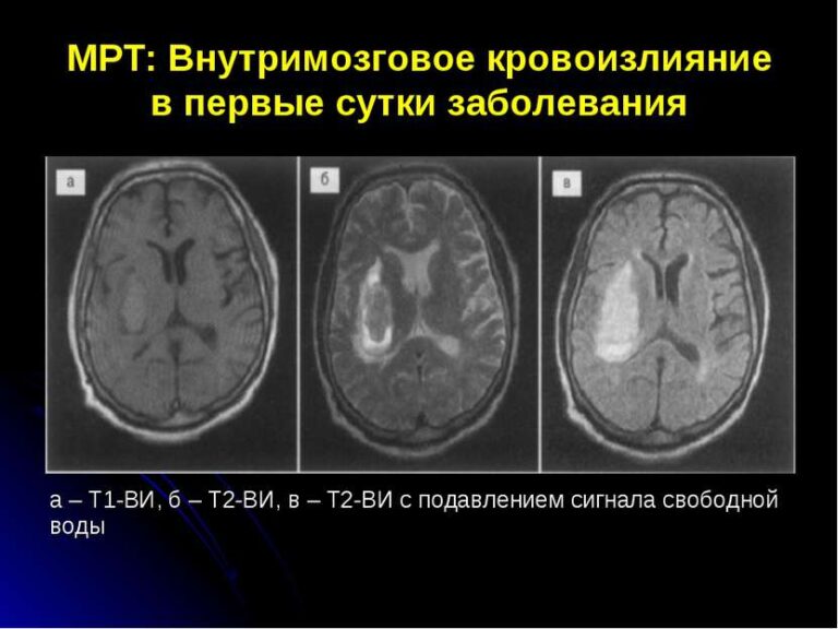 Мр картина косвенных признаков внутричерепной гипертензии