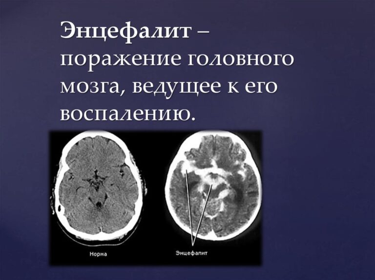 Черепно мозговая травма презентация хирургия