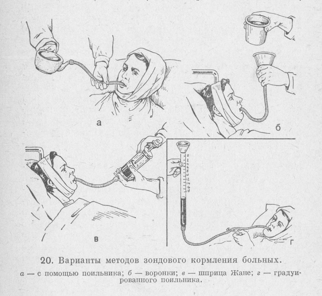 Зонд в домашних условиях. Питание пациента через назогастральный зонд. Кормление больных через назогастральный зонд. Зонд для питания лежачих больных. Кормление тяжелобольного пациента через назогастральный зонд.