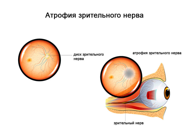 Ямка диска зрительного нерва диагностика