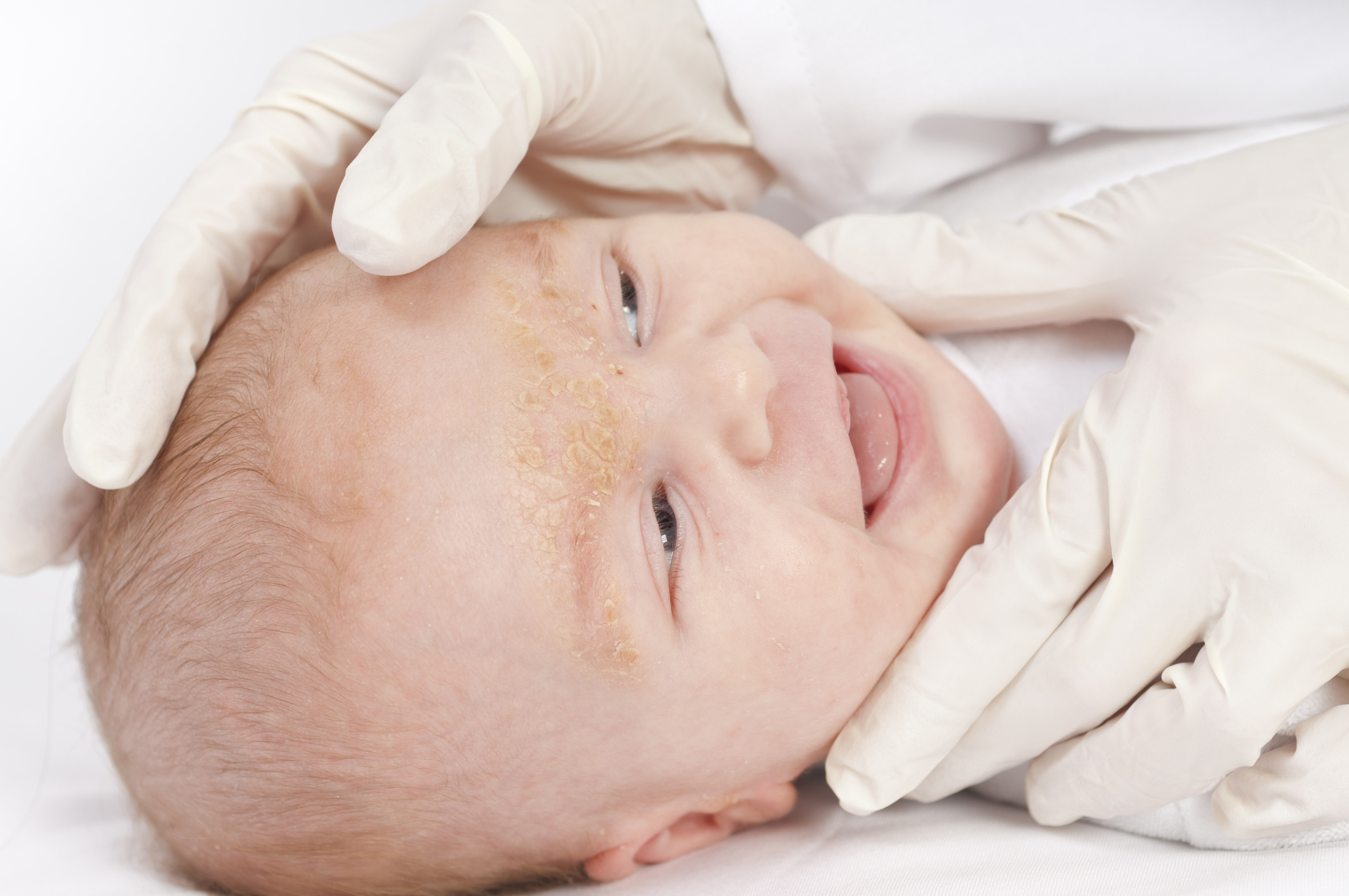 Экссудативно-катаральный диатез у новорожденного