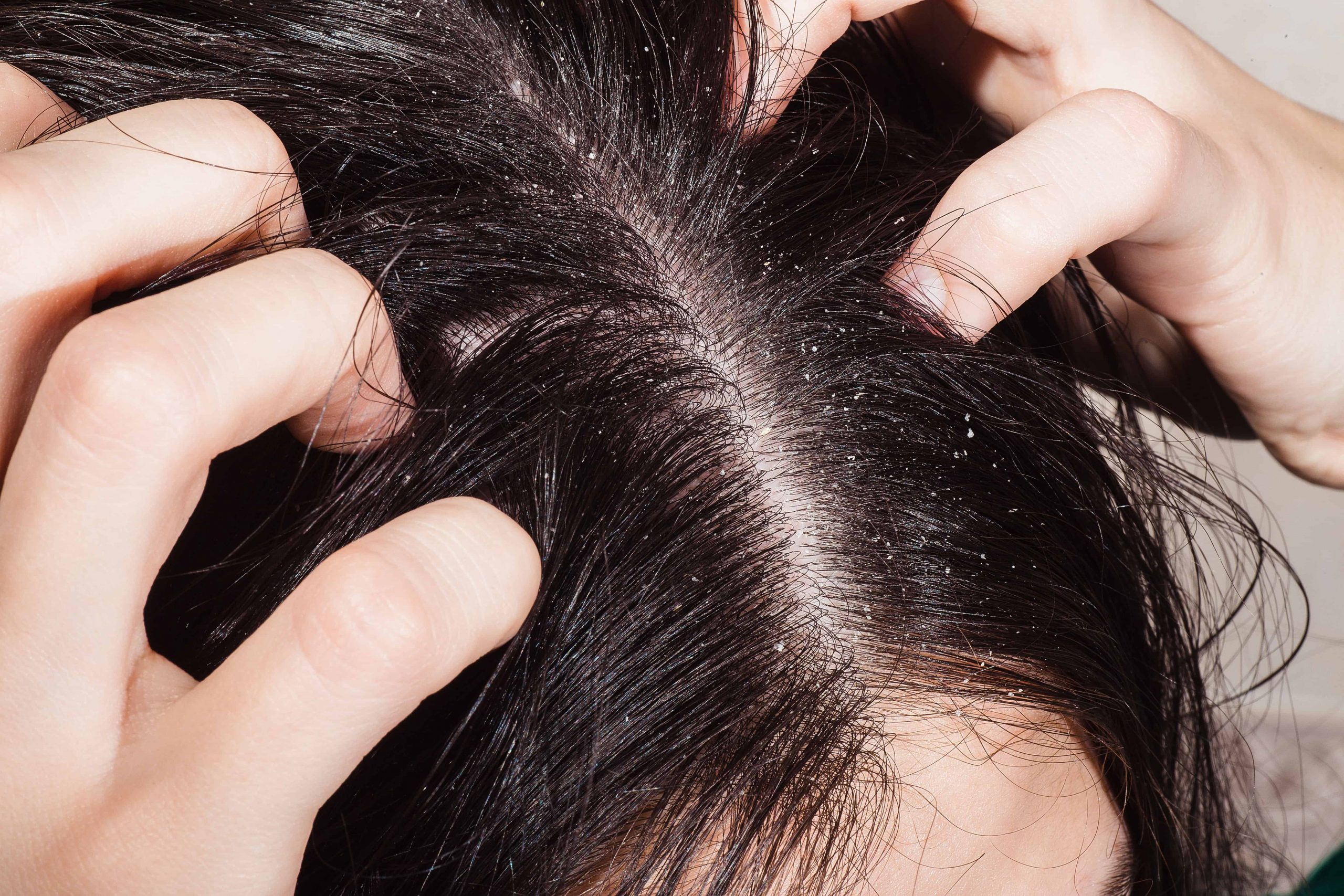 Стали выпадать волосы причины. Себорейный дерматит кожи волосистой части головы. Себорея и себорейный дерматит. Себорея волосяного Покрова.