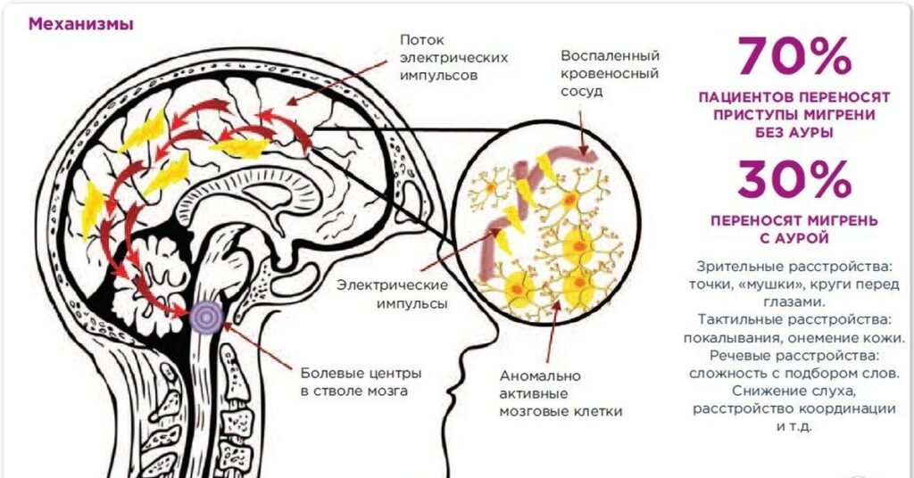 Мигрень на фоне месячных