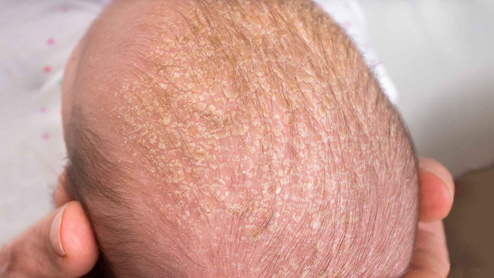 Почему у ребенка неприятно пахнут волосы