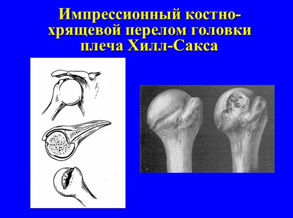 Переломы плечевой кости презентация