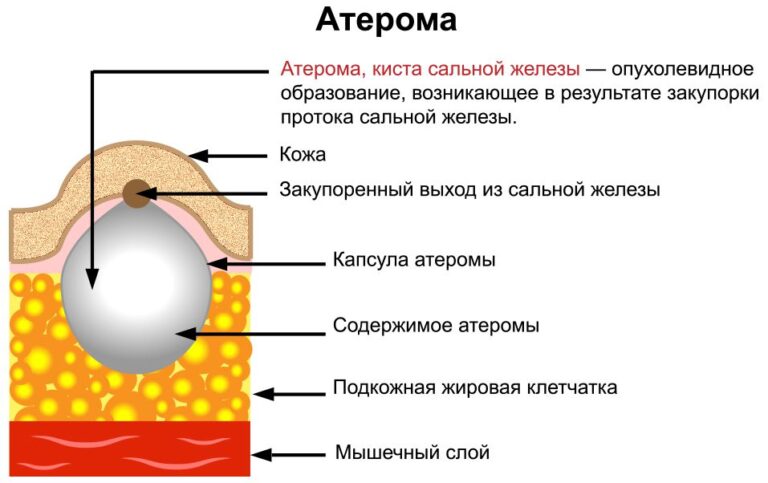 Атерома у мужчин фото