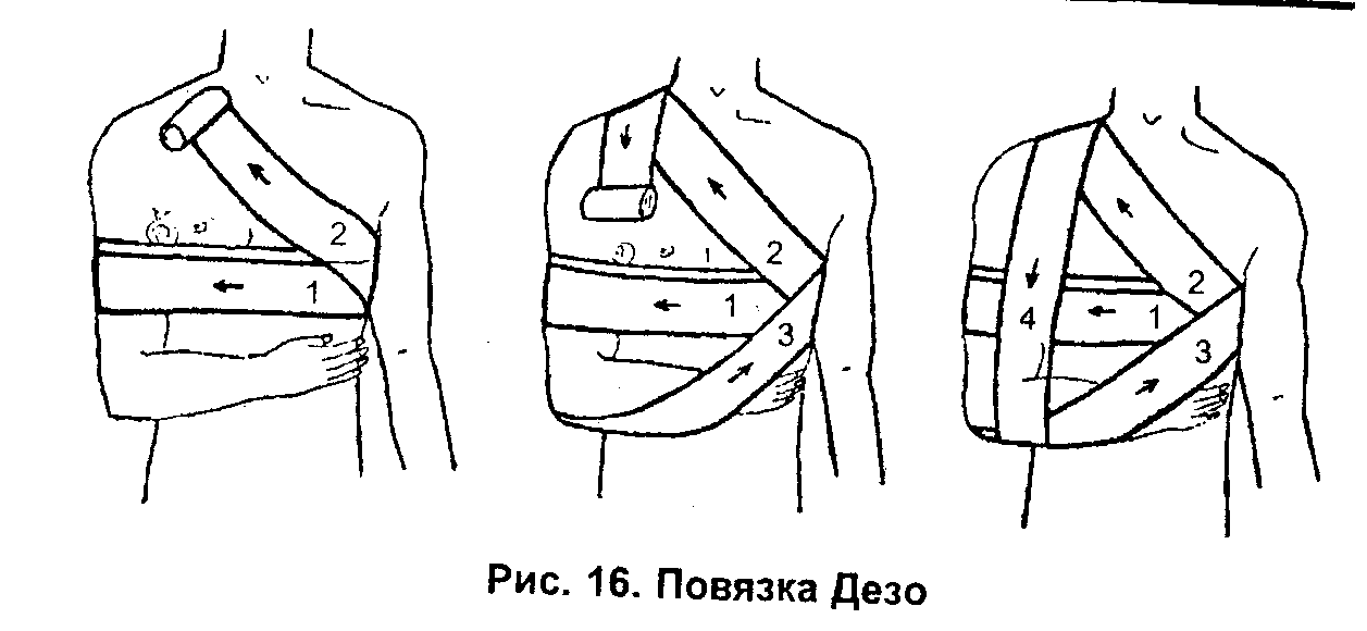 Повязка дезо схема