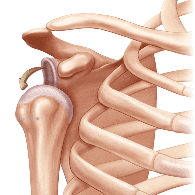 Вывих плечевого сустава картинки