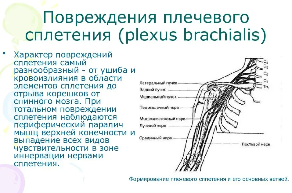 Поражение нервных сплетений. Схема нервов плечевого сплетения. Короткие ветви плечевого сплетения схема. Травматический плексит плечевого сплетения. Плечевое сплетение схема иннервация.