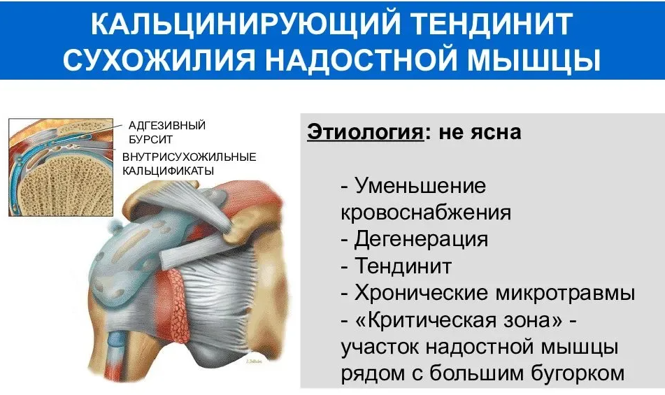 Сухожилия подкостной мышцы плечевого сустава. Повреждение сухожилия надостной мышцы. Разрыв сухожилия надостной мышцы плечевого сустава. Тендинита сухожилия надостной мышцы.