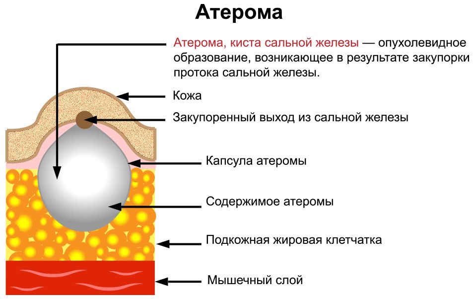 Атерома после удаления фото