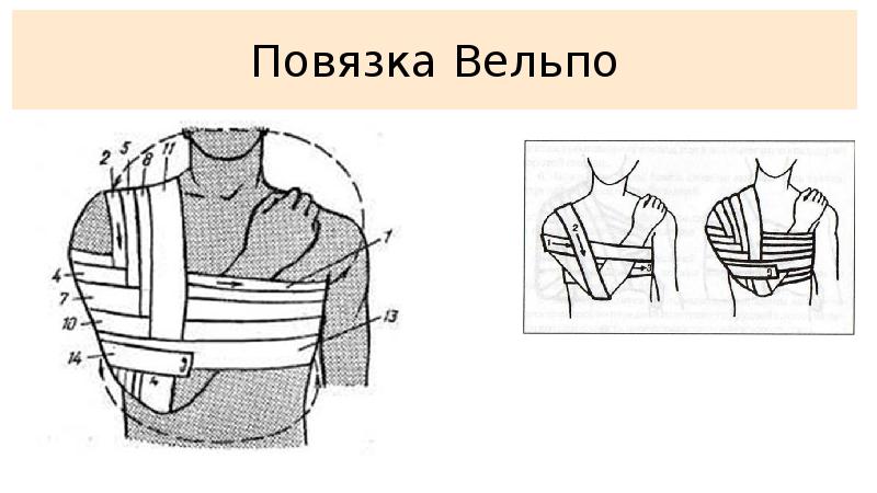 Дезо повязка на плечевой схема