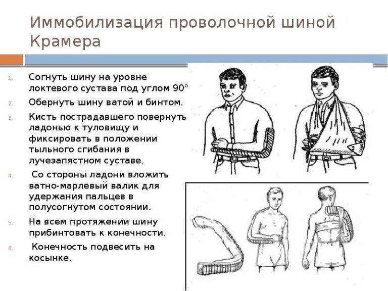 Как правильно спать при переломе плеча картинки