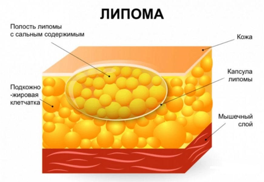 Липома подмышки фото