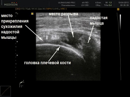 Компьютерная томография плечевого сустава что показывает