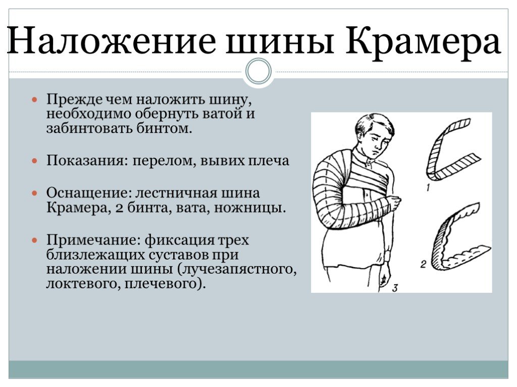 Сколько суставов необходимо зафиксировать при иммобилизации. Техника наложения шины Крамера алгоритм. Шину Крамера накладывают при переломе. Шина Крамера при переломе плеча техника наложения. Иммобилизация шиной Крамера.