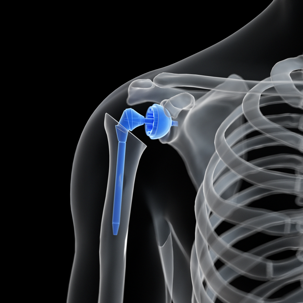 Презентация эндопротезирование плечевого сустава