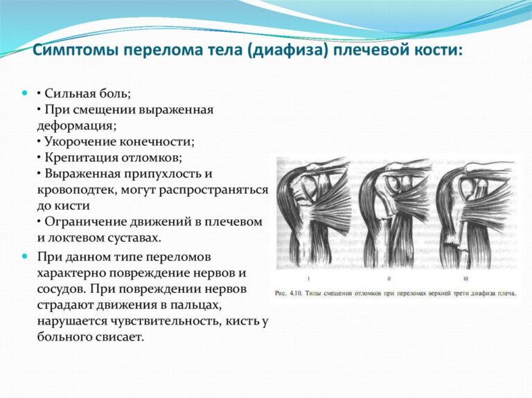 Клиническая картина переломов нижних конечностей