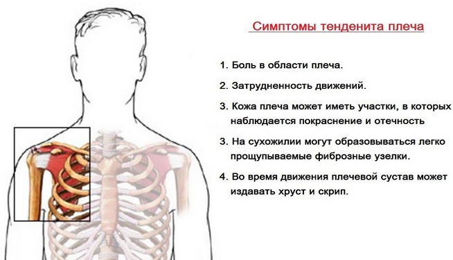 Сухожилие надостной мышцы плечевого сустава фото