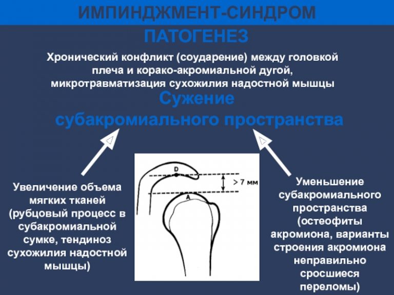 Основным эхографическим критерием синдрома денди уокера является