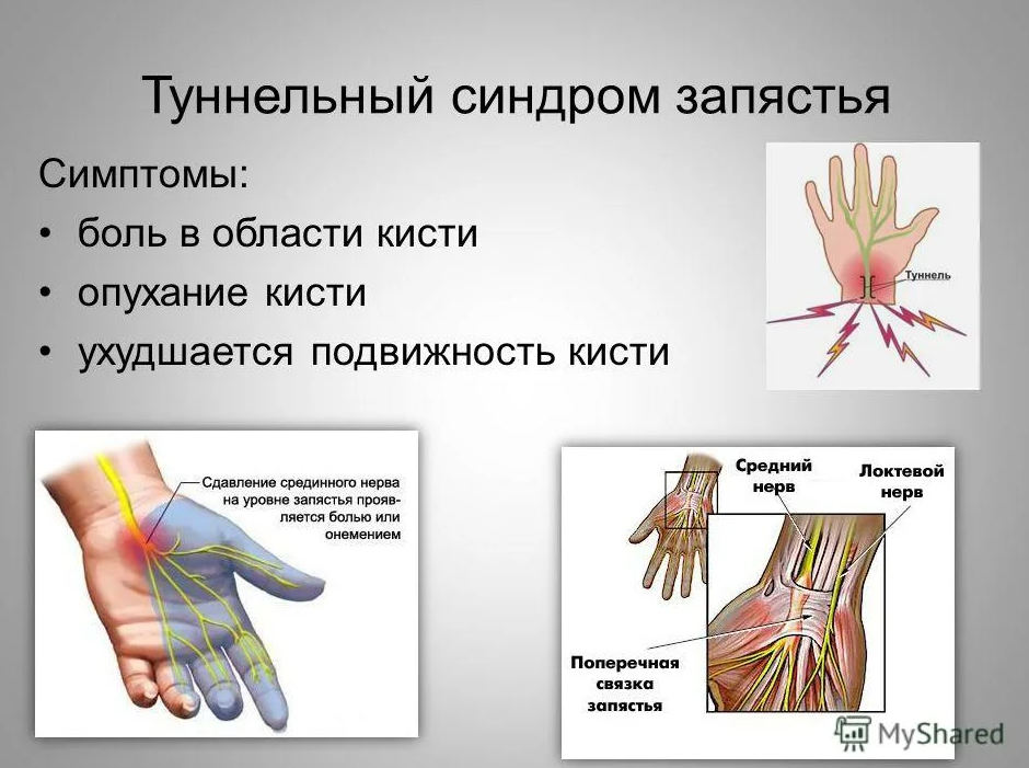 Запястьев или запястий. Карпальный (кистевой) туннельный синдром. Туннельный синдром лучезапястного сустава. Туннельный синдром запястья симптомы. Карпальный туннельный синдром симптомы.