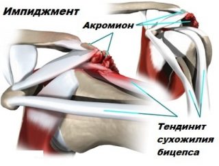 Тендинит двуглавой. Тендинит сухожилия бицепса. Тендинит дистального сухожилия бицепса. Тендинит сухожилия длинной головки. Тендинит сухожилия длинной головки бицепса плечевого.