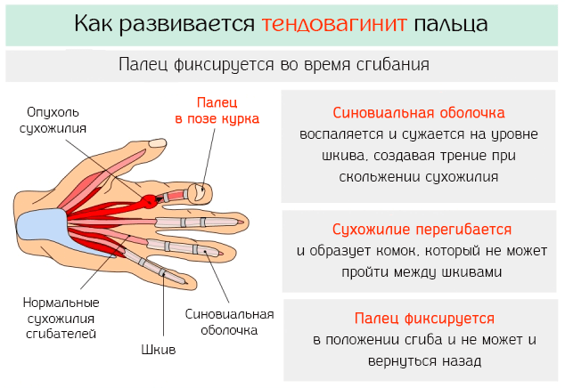 Тендинит трицепса фото