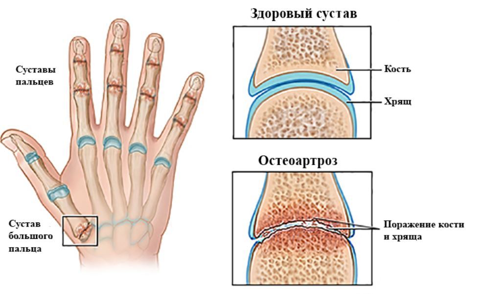 Болел большой палец на руке