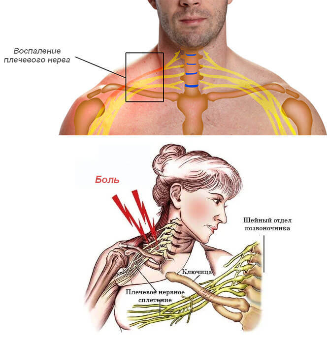 Почему воспаляется нерв. Плексит неврит плечевого нерва. Неврит (плексит) плечевого сплетения.. Плексит плеча симптомы. Нерв плечевого сплетения воспаление.