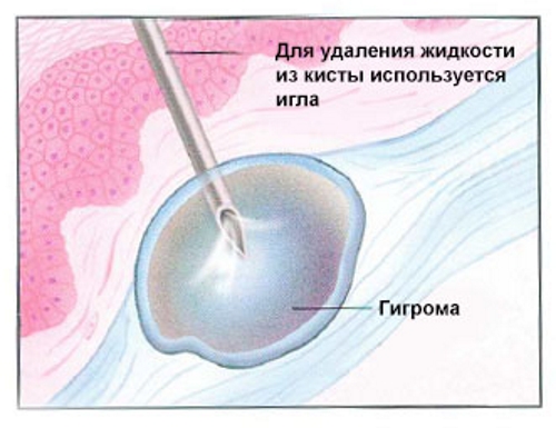 Гигрома на коленке фото