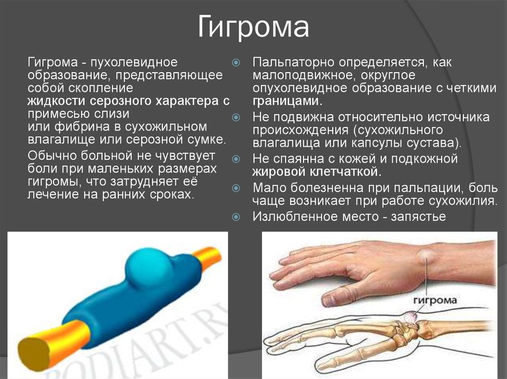 Гигрома на подошве стопы фото