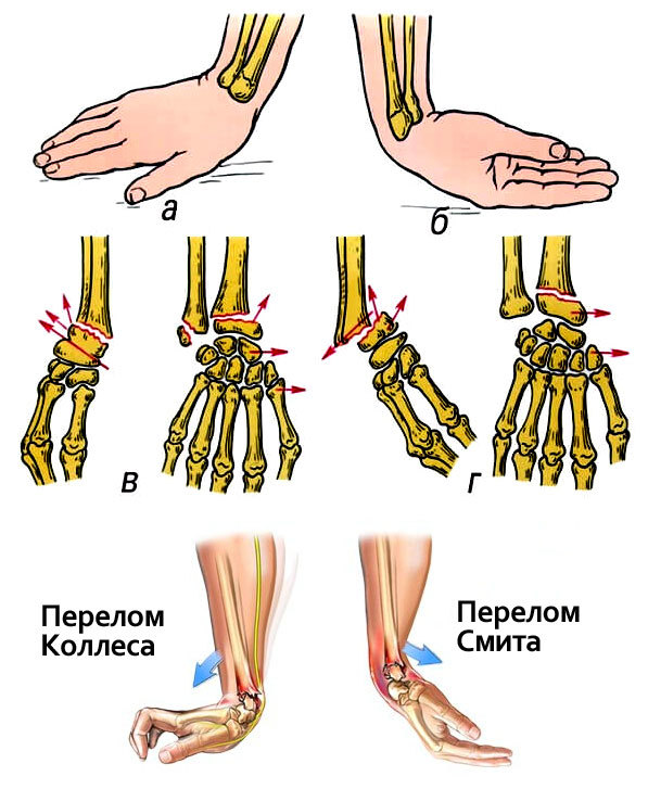 Перелом кисти руки фото