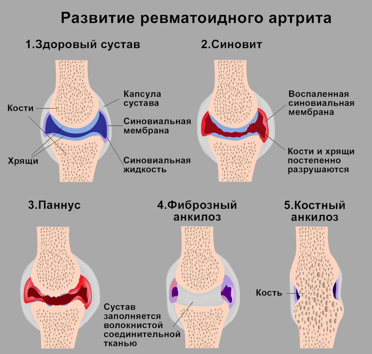 Ревматический полиартрит и ревматоидный артрит